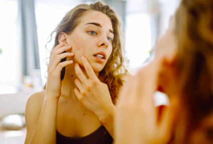 Struggling with Acne? The Best Korean Skincare Routine for Clear Skin